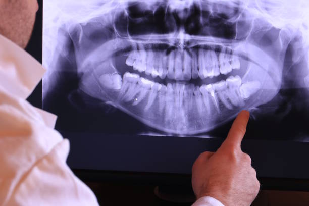 Best Emergency Wisdom Tooth Extraction in Hayden, AL