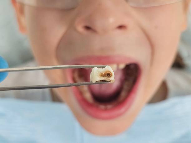 Best Broken or Chipped Tooth Repair in Hayden, AL